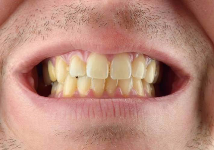 Vergilbte Zähne überdeckt durch ein gleichmäßiges Weiß von WellaSmile
