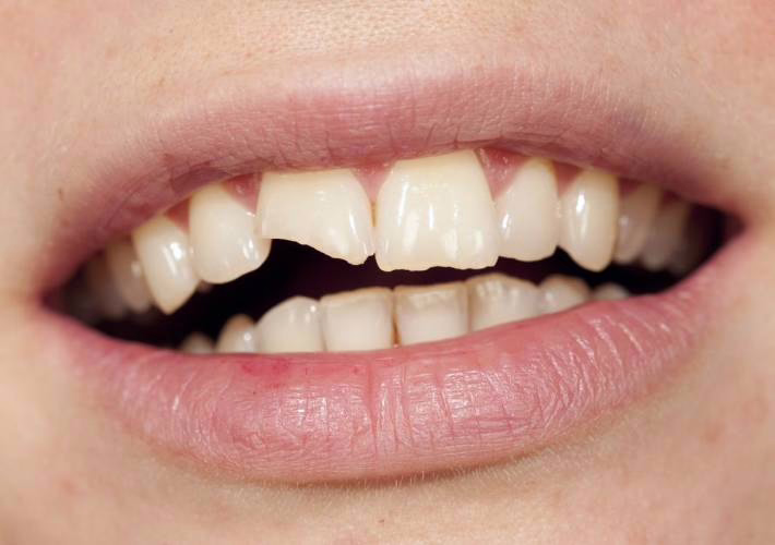 Abgebrochener Zahn geglättet durch WellaSmile