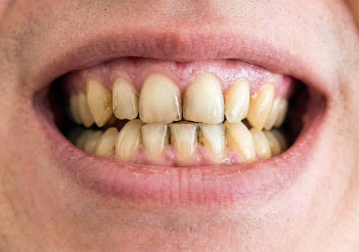 Zahnverfärbungen überdeckt durch WellaSmile